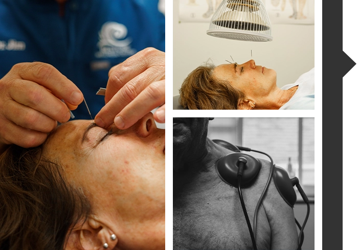 Collage Of Acupuncture And Cupping Therapy