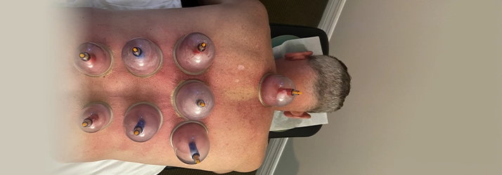 Man Receiving Cupping Therapy